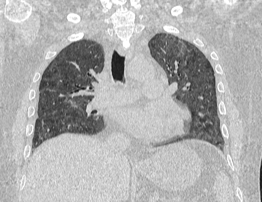 Non specific interstitial pneumonia (NSIP) (Radiopaedia 89725-106798 Coronal lung window 40).jpg