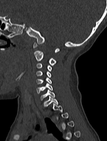 Normal CT cervical spine - pediatric (Radiopaedia 52549-58462 Sagittal bone window 148).jpg