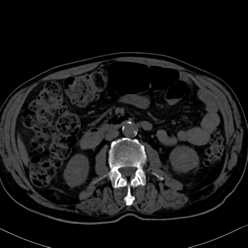 File:Normal CT intravenous cholangiogram (Radiopaedia 38199-40208 Axial IVC 57).png