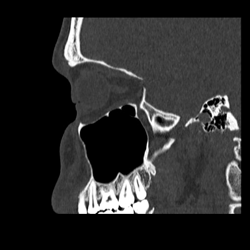 Normal CT paranasal sinuses (Radiopaedia 42286-45390 Sagittal bone window 75).jpg