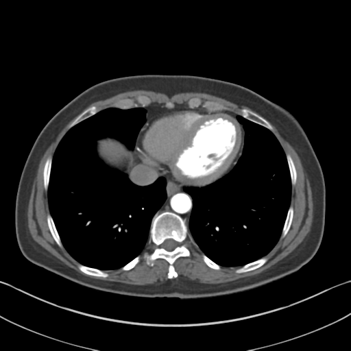 File:Normal CT renal artery angiogram (Radiopaedia 38727-40889 A 3).png