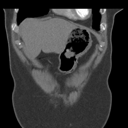 File:Normal CT renal artery angiogram (Radiopaedia 38727-40889 B 14).png
