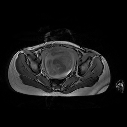 File:Normal MRI abdomen in pregnancy (Radiopaedia 88001-104541 Axial Gradient Echo 47).jpg