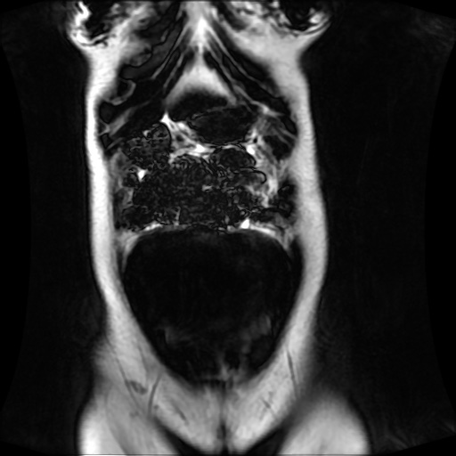 Normal MRI abdomen in pregnancy (Radiopaedia 88001-104541 N 35).jpg