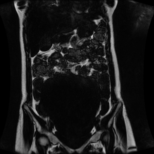 Normal MRI abdomen in pregnancy (Radiopaedia 88001-104541 N 56).jpg