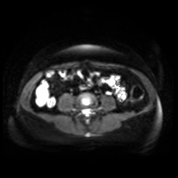 Normal MRI abdomen in pregnancy (Radiopaedia 88005-104548 Axial DWI 35).jpg