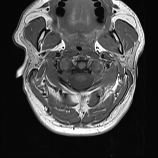 File:Normal MRI cervical spine (infection protocol) (Radiopaedia 53916-60039 Axial 11).png