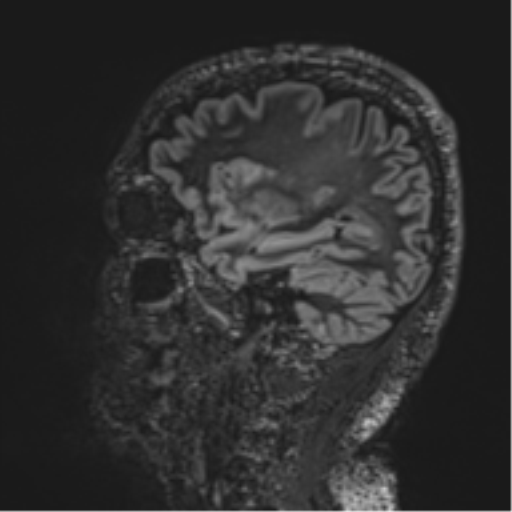 Normal brain MRI (non-focal epilepsy protocol) (Radiopaedia 53917-60040 Sagittal DIR 44).png
