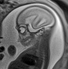 Normal brain fetal MRI - 22 weeks (Radiopaedia 50623-56050 Sagittal T2 Haste 7).jpg