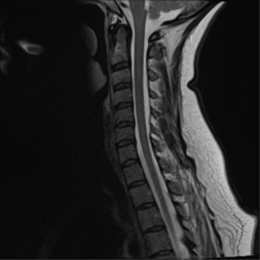 File:Normal cervical spine MRI (including Dixon) (Radiopaedia 42762-45925 Dixon- in-phase 8).png