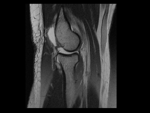 File:Normal elbow arthrograms (Radiopaedia 75550-86805 Sagittal PD 15).jpg