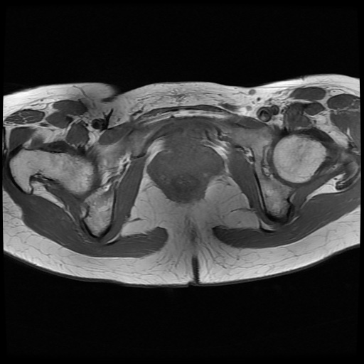 File:Normal female pelvis MRI (retroverted uterus) (Radiopaedia 61832-69933 Axial T1 24).jpg