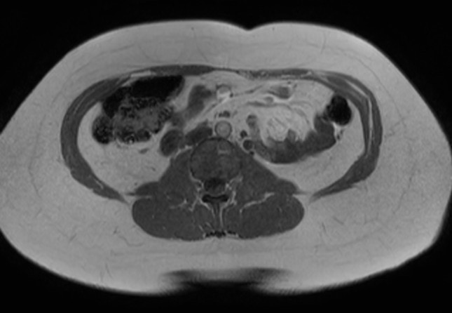 File:Normal liver MRI with Gadolinium (Radiopaedia 58913-66163 Axial T1 in-phase 5).jpg