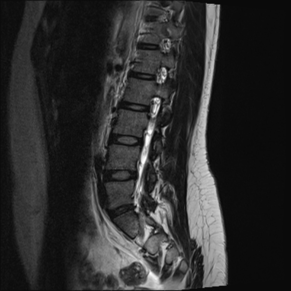 File:Normal lumbar spine MRI- 3 T (Radiopaedia 53280-59250 Sagittal T2 17).jpg