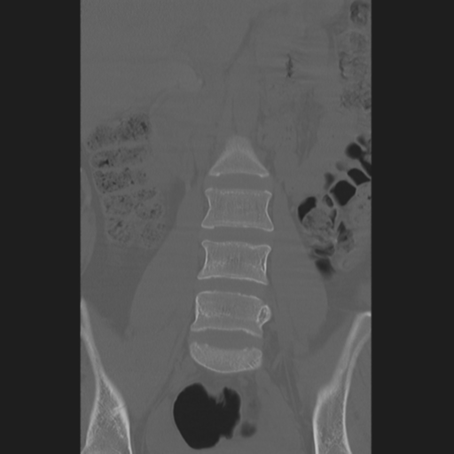 File:Normal lumbosacral CT (Radiopaedia 37923-39867 Axial bone window 1).png