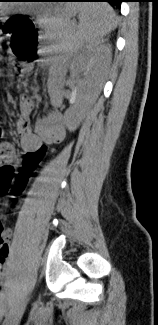 Normal lumbosacral CT (Radiopaedia 37923-39867 E 26).png
