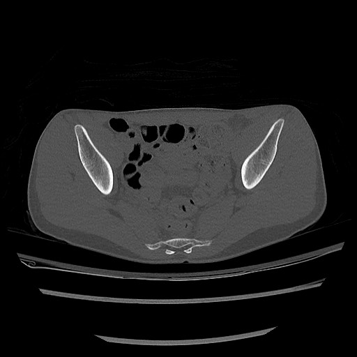 Normal pelvis CT (Radiopaedia 51471-57236 Axial bone window 52).jpg