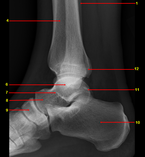 File:Normal radiographic anatomy of the ankle (Radiopaedia 42814-45987 B 1).jpg
