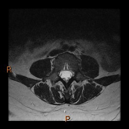 File:Normal spine MRI (Radiopaedia 77323-89408 Axial T2 11).jpg