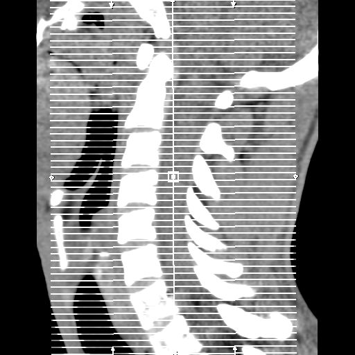 Normal trauma cervical spine (Radiopaedia 41017-43760 Axial non-contrast 1).png