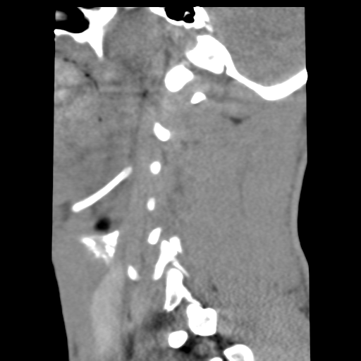 File:Normal trauma cervical spine (Radiopaedia 41017-43760 B 6).png