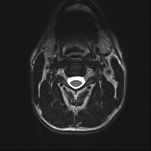 Normal trauma cervical spine (Radiopaedia 41017-43762 D 14).png