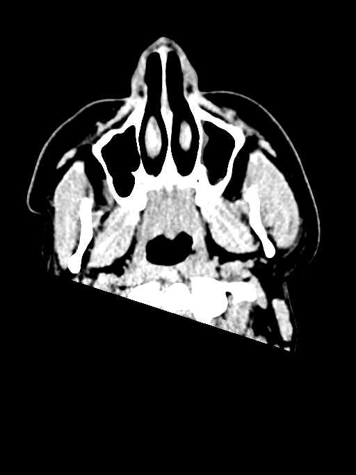 Normal trauma protocol brain and C-spine CT (Radiopaedia 83302-97709 Axial non-contrast 74).jpg