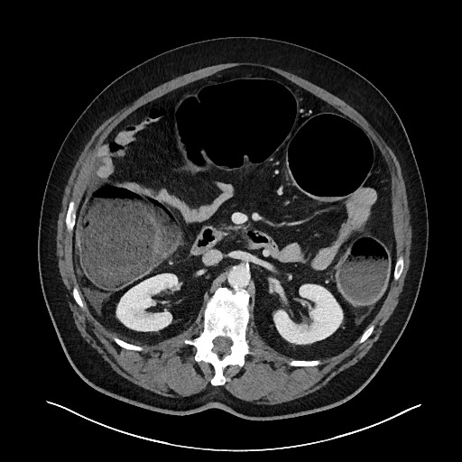 Obstructing sigmoid adenocarcinoma (Radiopaedia 58465-65619 A 65).jpg