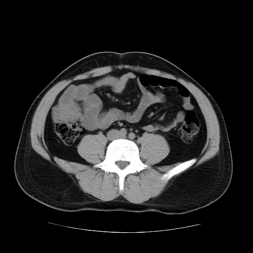 File:Obstructing ureteric calculus (Radiopaedia 18615-18514 Axial non-contrast 34).jpg