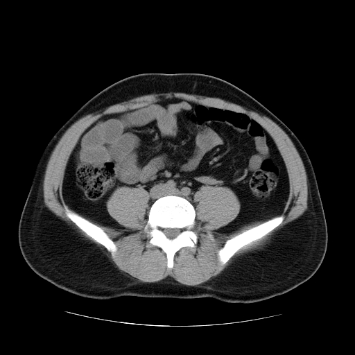 File:Obstructing ureteric calculus (Radiopaedia 18615-18514 Axial non-contrast 35).jpg