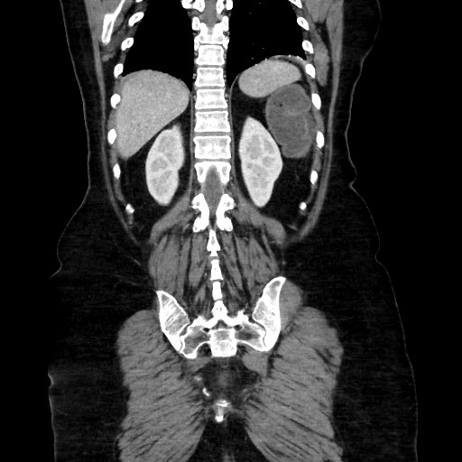 Obstructive distal colonic adenocarcinoma causing cecal perforation (Radiopaedia 86830-102989 C 135).jpg