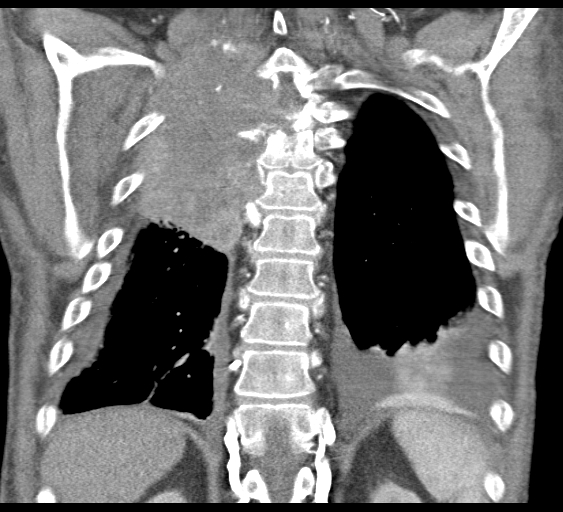 File:Obstructive superior vena cava tumor thrombus (Radiopaedia 28046-28306 B 40).jpg