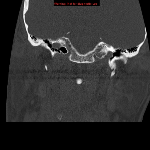File:Occipital condyle fracture (Radiopaedia 18366-18208 Coronal bone window 2).jpg