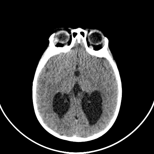 Occipital encephalocele (Radiopaedia 87339-103636 Axial non-contrast 41).jpg