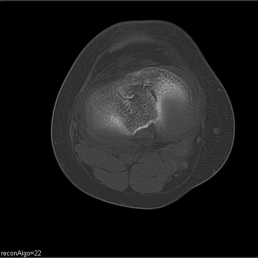 File:ACL avulsion fracture (Radiopaedia 33833-34994 Axial bone window 18).jpg