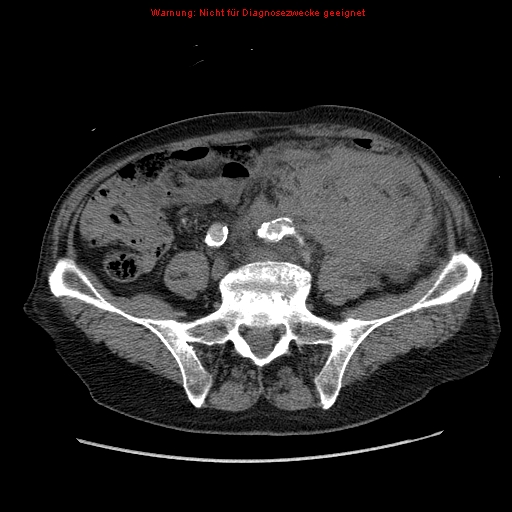 File:Abdominal aortic aneurysm- extremely large, ruptured (Radiopaedia 19882-19921 Axial C+ arterial phase 53).jpg