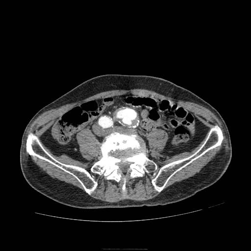 Abdominal aortic aneurysm (Radiopaedia 13341-13340 Axial C+ arterial phase 160).jpg