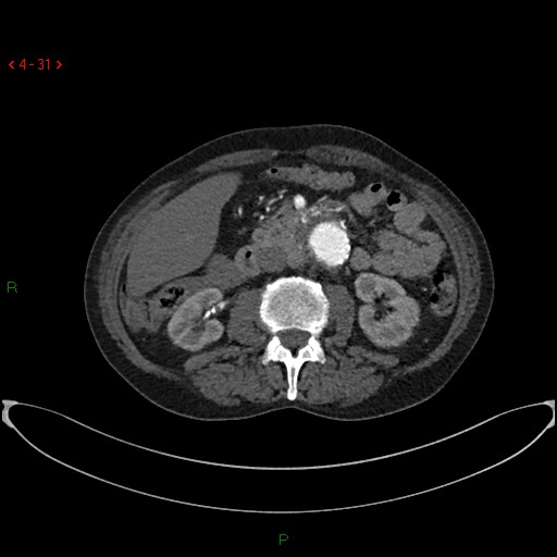 File:Abdominal aortic aneurysm (Radiopaedia 16155-15834 Axial C+ arterial phase 11).jpg