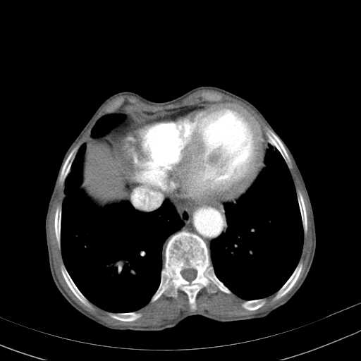 File:Abdominal aortic aneurysm (Radiopaedia 20827-20742 Axial C+ arterial phase 2).jpg