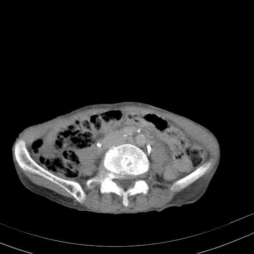 File:Abdominal aortic aneurysm (Radiopaedia 20827-20742 Axial C+ delayed 20).jpg