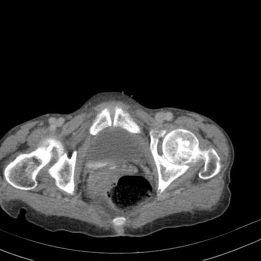 File:Abdominal aortic aneurysm (Radiopaedia 20827-20742 Axial C+ delayed 37).jpg