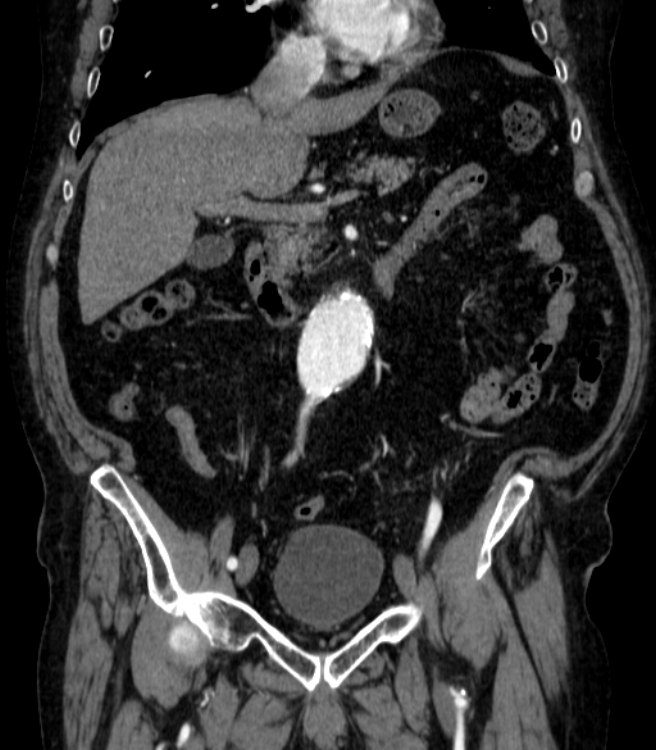 Abdominal aortic aneurysm (Radiopaedia 25855-26001 Coronal C+ arterial phase 23).jpg