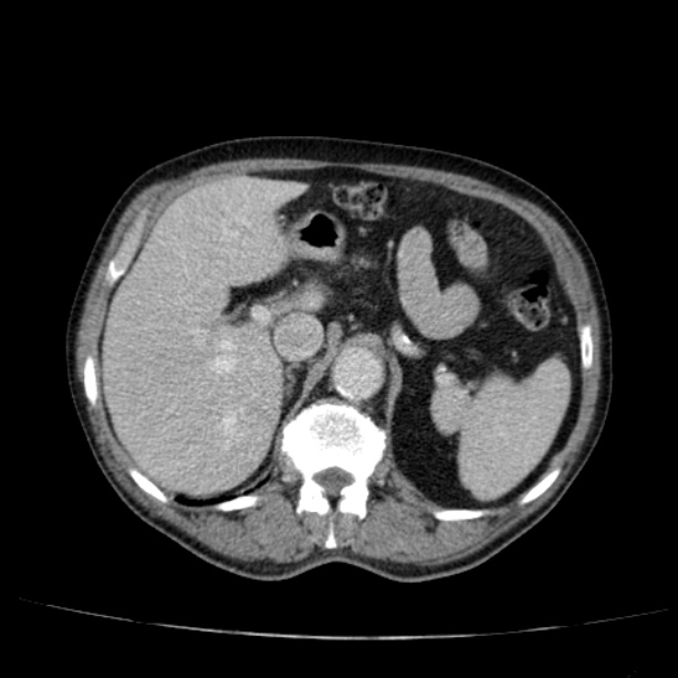 Abdominal aortic aneurysm (Radiopaedia 29248-29660 Axial C+ portal venous phase 17).jpg
