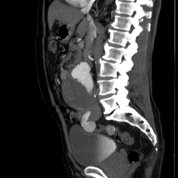 Abdominal aortic aneurysm (Radiopaedia 29248-29660 Sagittal C+ arterial phase 25).jpg