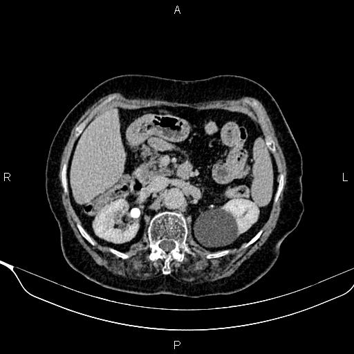 File:Abdominal aortic aneurysm (Radiopaedia 85063-100606 Axial C+ delayed 34).jpg
