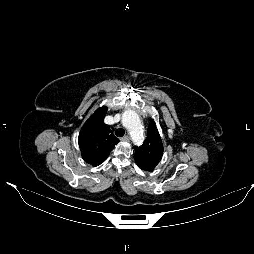 File:Abdominal aortic aneurysm (Radiopaedia 85063-100606 Axial C+ portal venous phase 10).jpg