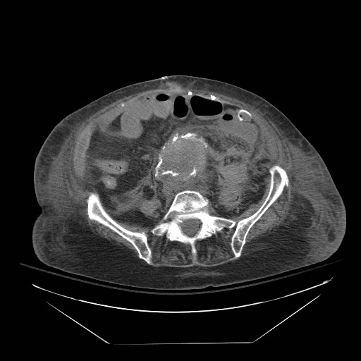 Abdominal aortic aneurysm - impending rupture (Radiopaedia 19233-19247 Axial non-contrast 113).jpg