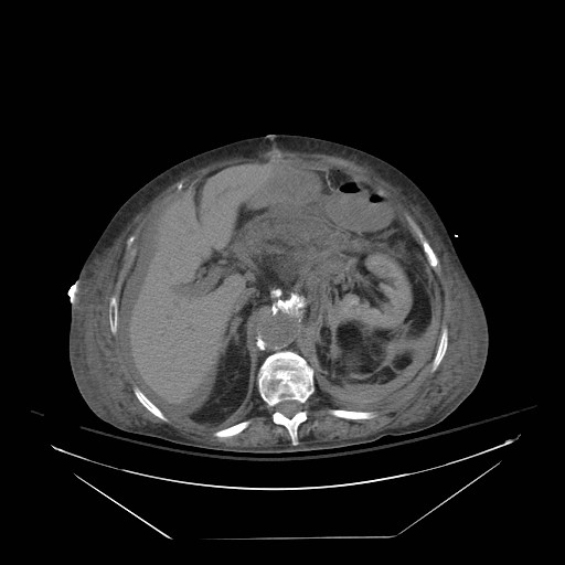 Abdominal aortic aneurysm - impending rupture (Radiopaedia 19233-19247 Axial non-contrast 57).jpg