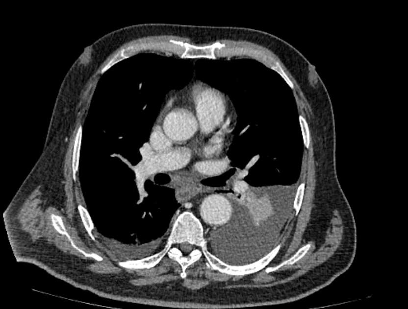 Abdominal aortic aneurysm rupture (Radiopaedia 54179-60362 Axial C+ portal venous phase 43).jpg