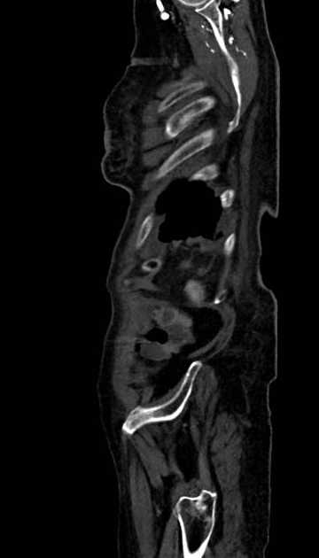 Abdominal aortic aneurysm with thrombus fissuration (Radiopaedia 73192-83919 Sagittal C+ arterial phase 6).jpg